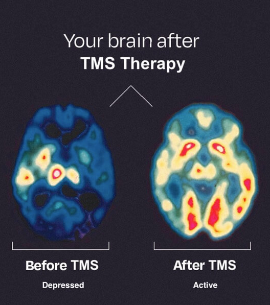 tms therapy