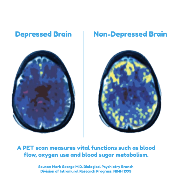 depressed brain